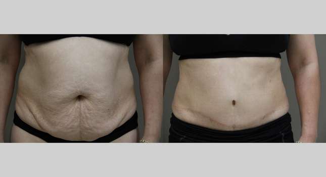 Tummy Tuck: Image #1077