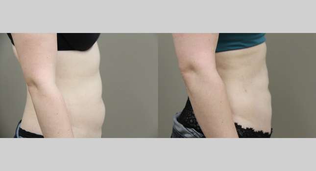 Liposuction: Image #1078