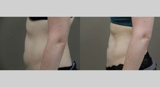 Liposuction: Image #1079