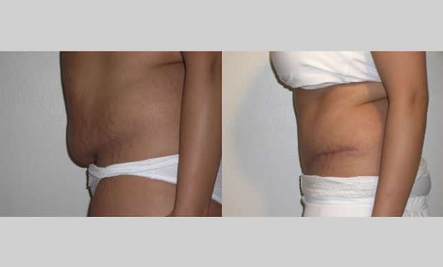 Tummy Tuck: Image #108
