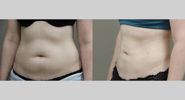 Liposuction: Image #1080