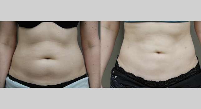 Liposuction: Image #1081