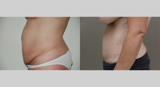 Tummy Tuck: Image #1082