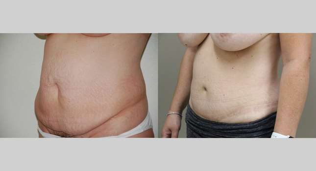 Tummy Tuck: Image #1083