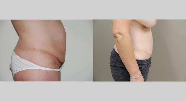 Tummy Tuck: Image #1084