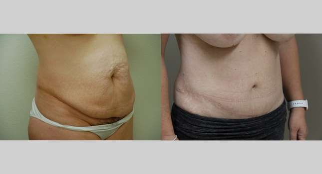 Tummy Tuck: Image #1085