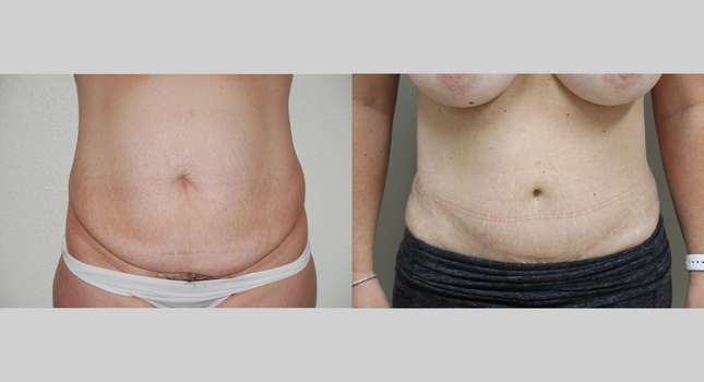Tummy Tuck: Image #1086