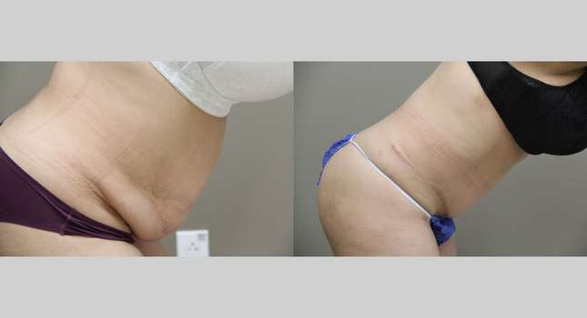Tummy Tuck: Image #1087