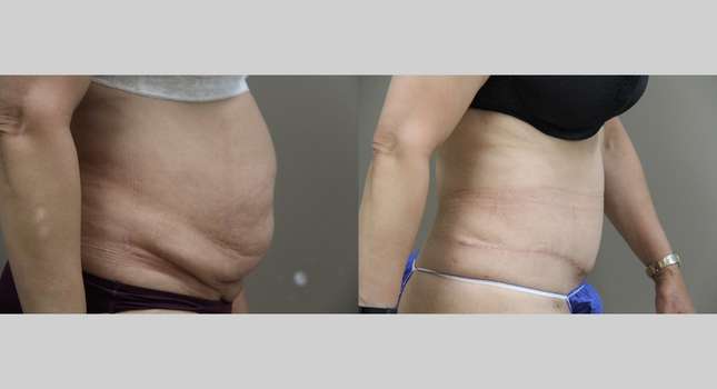 Tummy Tuck: Image #1088