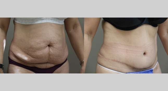 Tummy Tuck: Image #1089