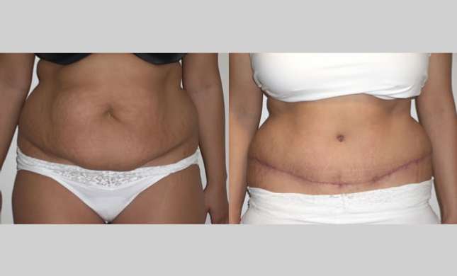 Tummy Tuck: Image #109