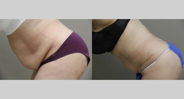 Tummy Tuck: Image #1090