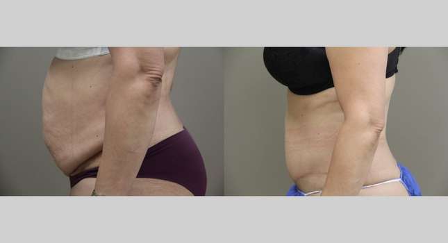 Tummy Tuck: Image #1091