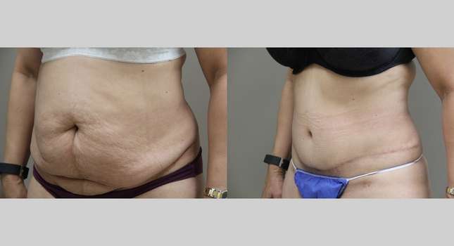 Tummy Tuck: Image #1092