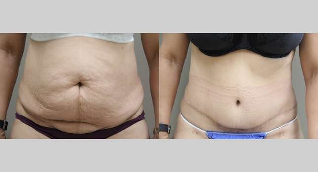 Tummy Tuck: Image #1093