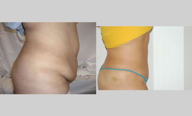 Tummy Tuck: Image #110