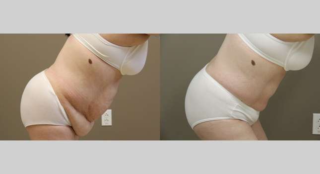 Tummy Tuck: Image #1108