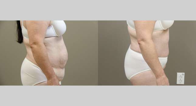Tummy Tuck: Image #1109
