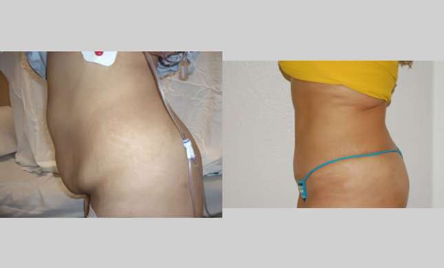 Tummy Tuck: Image #111