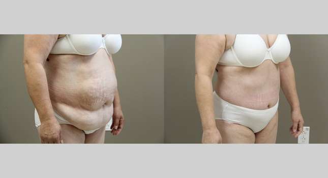 Tummy Tuck: Image #1110