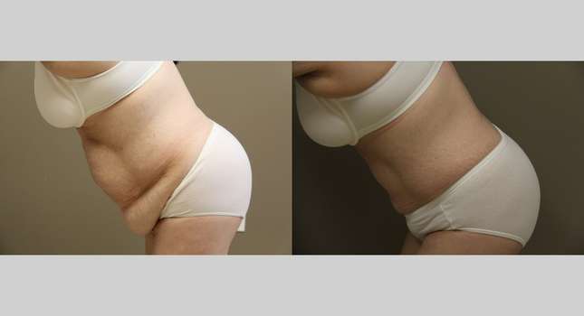 Tummy Tuck: Image #1111