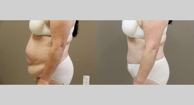 Tummy Tuck: Image #1112
