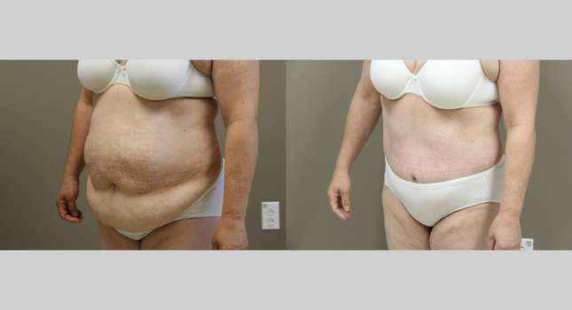Tummy Tuck: Image #1113