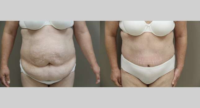 Tummy Tuck: Image #1114