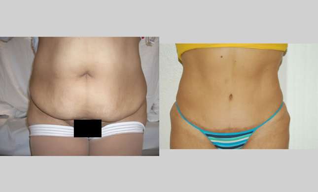 Tummy Tuck: Image #112