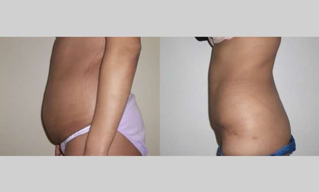 Tummy Tuck: Image #113