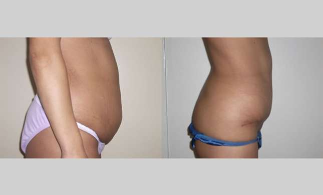 Tummy Tuck: Image #114