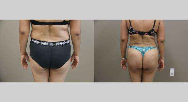 Liposuction: Image #1146