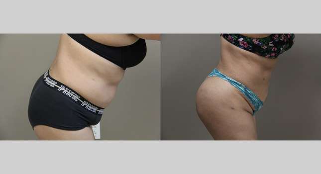 Liposuction: Image #1147