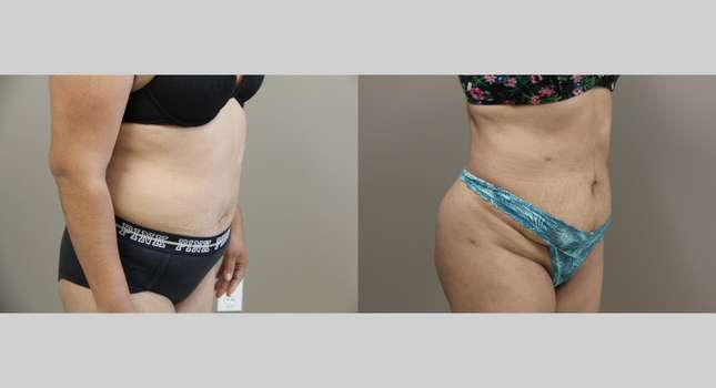 Liposuction: Image #1149