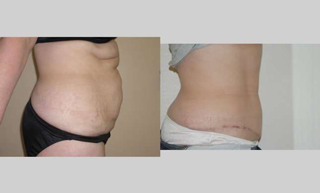 Tummy Tuck: Image #115