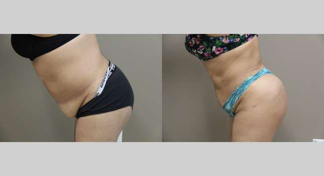 Liposuction: Image #1150
