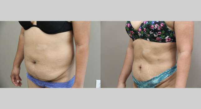 Liposuction: Image #1152