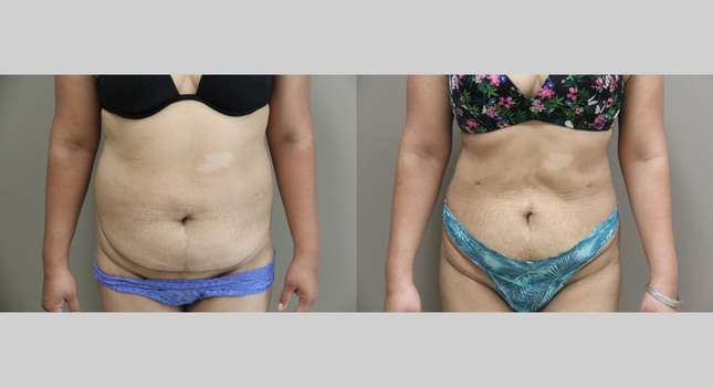 Liposuction: Image #1153
