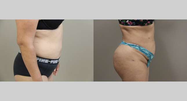 Butock and Thigh Contouring: Image #1156