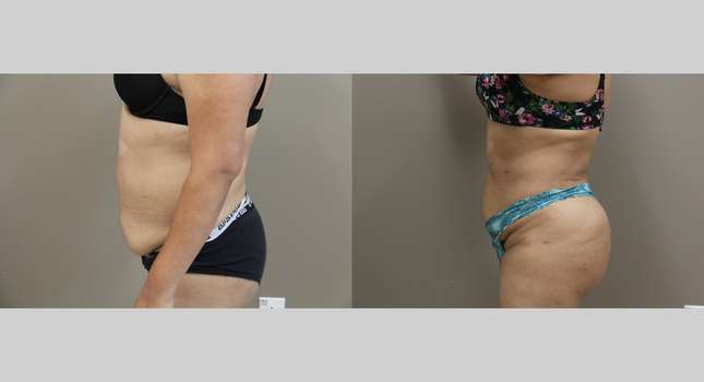 Butock and Thigh Contouring: Image #1157