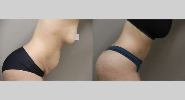 Tummy Tuck: Image #1158