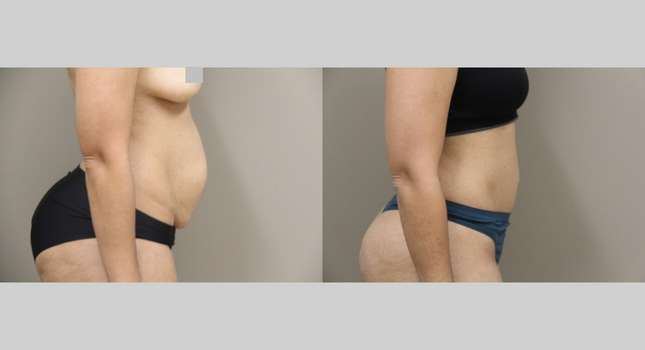 Tummy Tuck: Image #1159