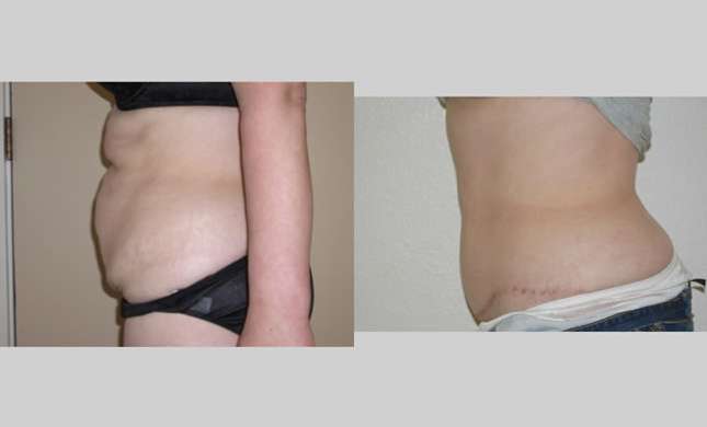 Tummy Tuck: Image #116