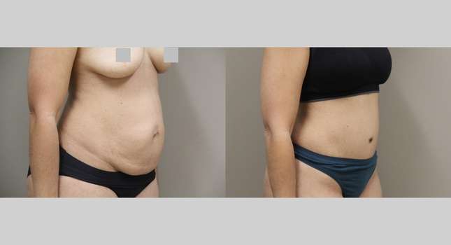 Tummy Tuck: Image #1160