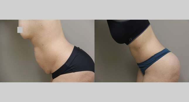 Tummy Tuck: Image #1161