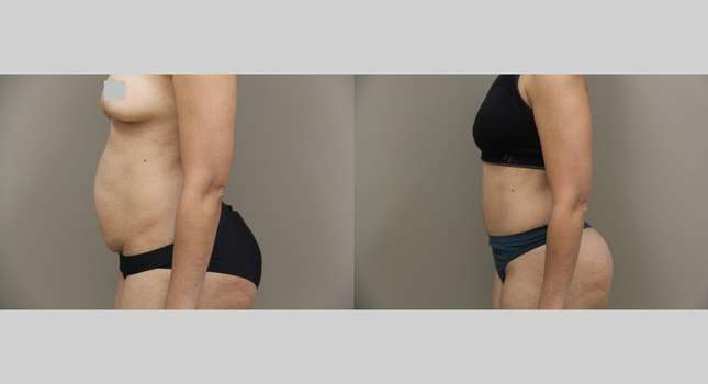Tummy Tuck: Image #1162