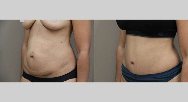 Tummy Tuck: Image #1163