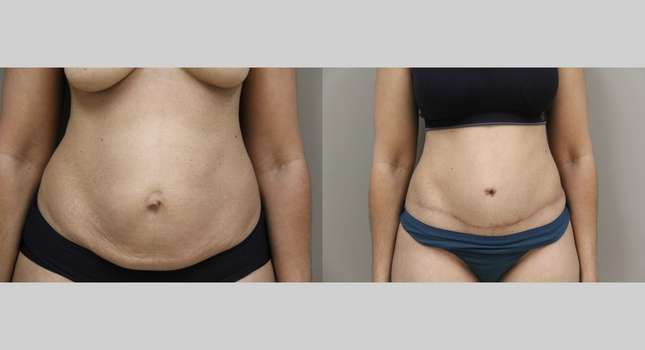 Tummy Tuck: Image #1164