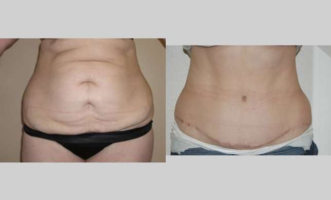 Tummy Tuck: Image #117