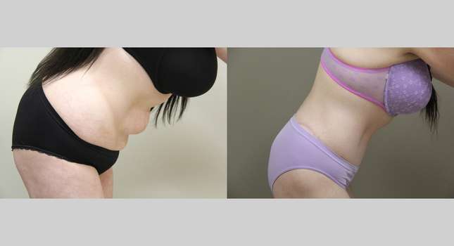 Body Lift: Image #1175